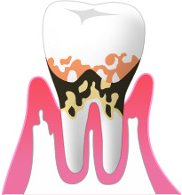 ④中度の歯周病
